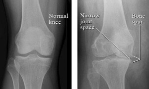 Arthritis Knee LIVE EVERY DAY